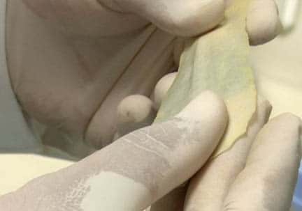 ساخت پوست مصنوعی برای کمک به قربانیان اسیدپاشی