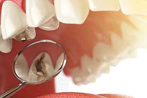 چگونه از پوسیدگی دندان جلوگیری کنیم