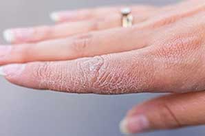 علت خشکی پوست و شیوه‌های درمان و جلوگیری