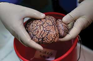 مغز برخی بیماران  کرونا تا ۱۰ سال پیرتر شده است