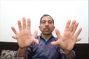 تصاویر | مرد هندی که ۲۸ انگشت دارد!