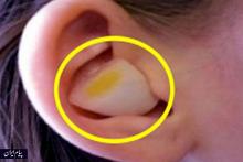  درمان عفونت گوش با یک حبه سیر؟!